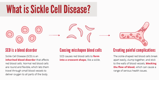 Sickle Cell Disease Sickle Cell Disease